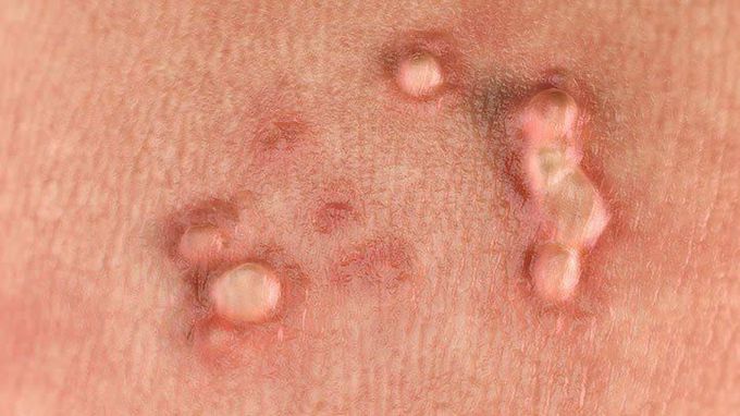 Genital warts