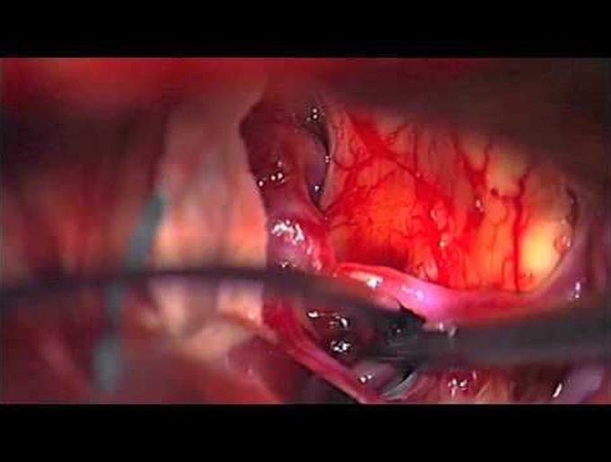 Translamina terminalis route via pterional approach to resect retrochiasmatic craniopharyngioma ...