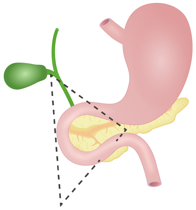 Gastrinoma Triangle