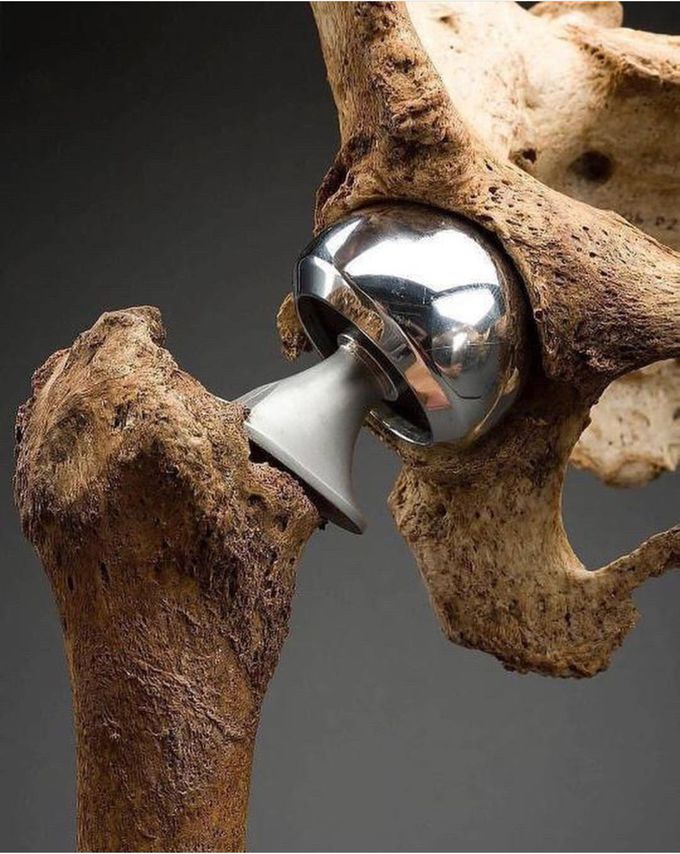 Which type  of  bone surgery  this  one.can guess