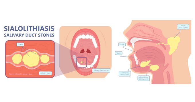 Salivary Stones (Sialolithiasis)