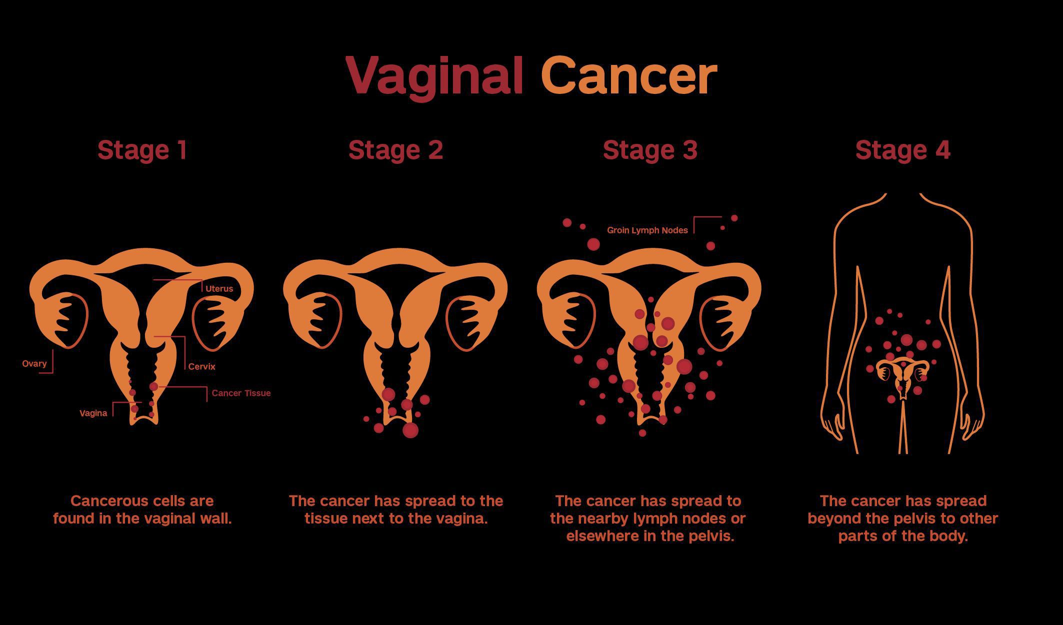 The vulva - vulval cancer and lymph nodes in the groin