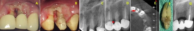 Tissue Necrosis In Drug Addict Because Of Chloroform
