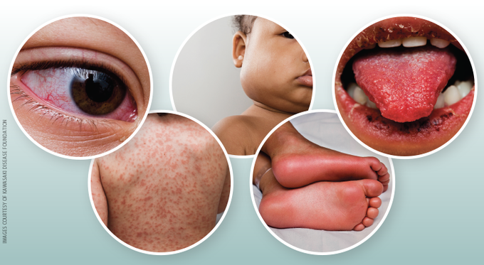 Diagnostic Guidelines for Kawasaki Disease