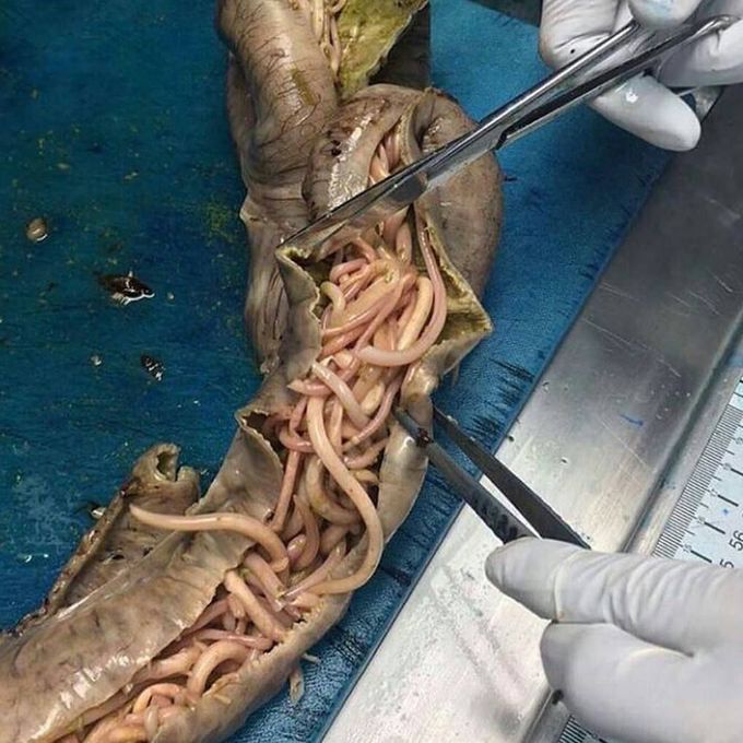 SMALL INTESTINE HEAVILY INFECTED WITH ASCARIS  LUMBRICOIDES