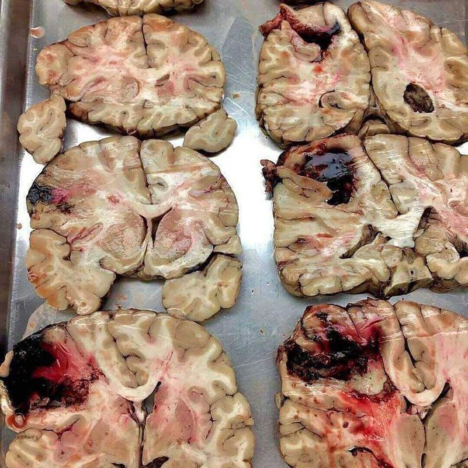 Hemorrhagic stroke.