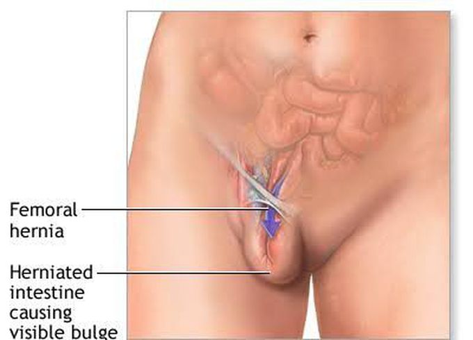 Femoral hernia