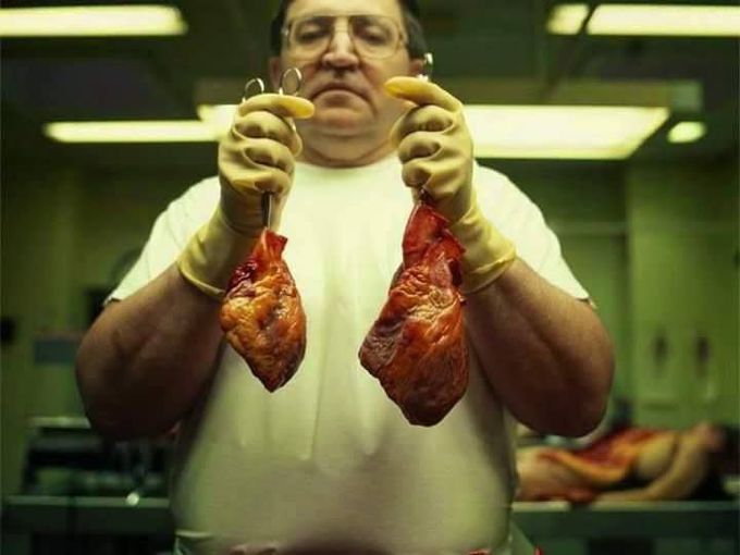 Normal heart vs cardiomegaly !!