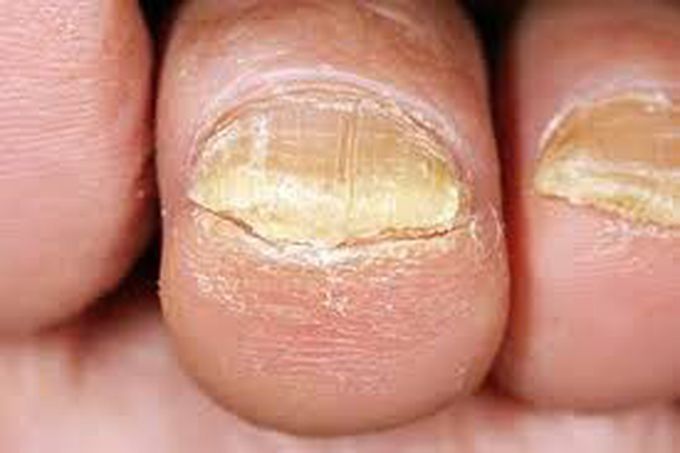 A fungal nail infection is a common condition that can leave you with brittle, discolored nails, usually on your toes.

Its formal name is onychomycosis, and it’s a lot like athlete’s foot. But instead of affecting the skin on the bottom of your feet or between your toes, it invades your nails.


Fungi are tiny organisms you can only see through a microscope. Many different types can cause a nail infection. Sometimes they live on your skin and don’t make any trouble. But if you have a lot in one area, you might get infected.🙂✌