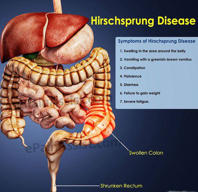 Symptoms of Hirschsprung