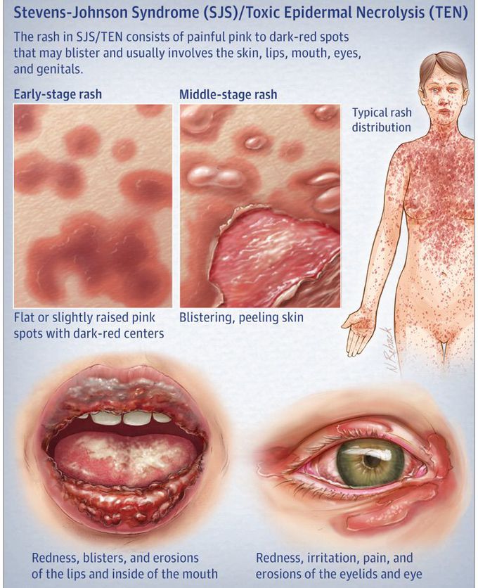 Stevens-Johnson Syndrome