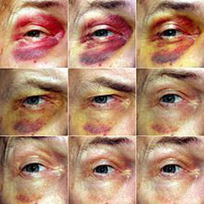 black eye