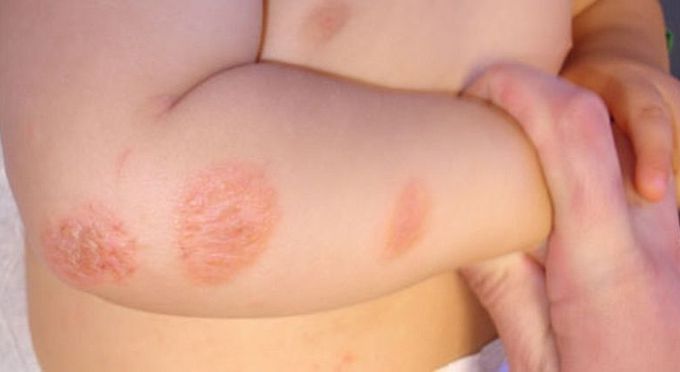 Skin disease