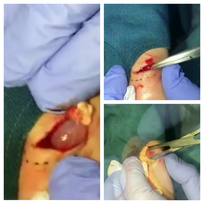 Ganglion cyst