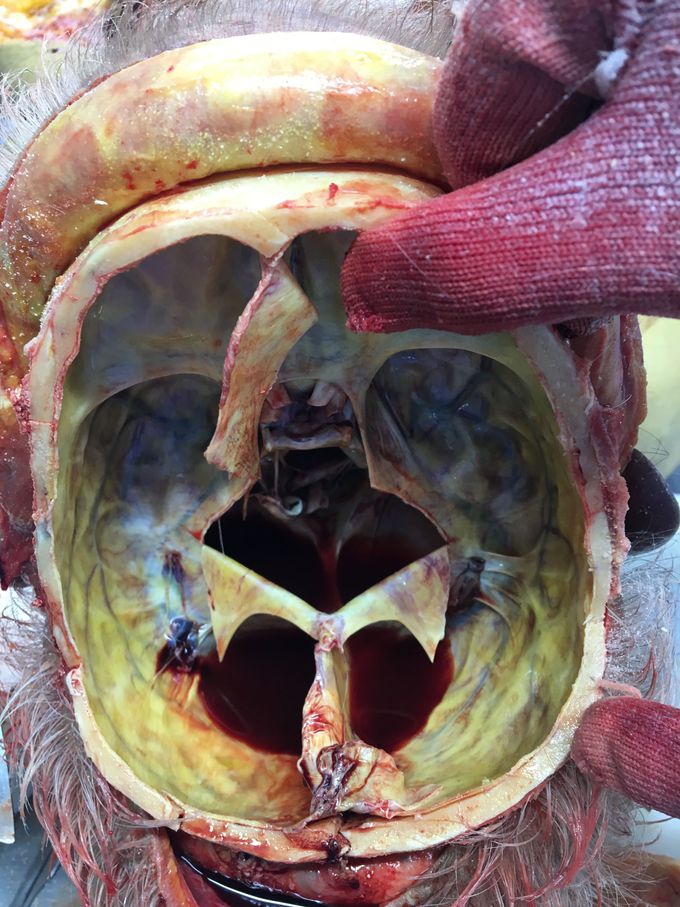 Icteric dura mater