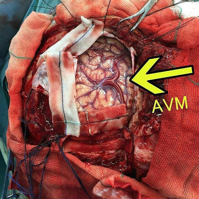 AVM