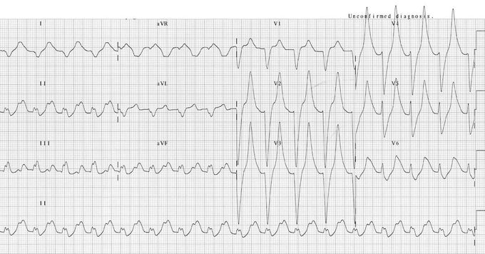 Peaked "T waves" on ECG in a patient with Hyperkalemia