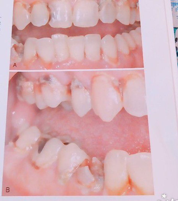 Acutr,Rampant caries in both anterior and posterior teeth