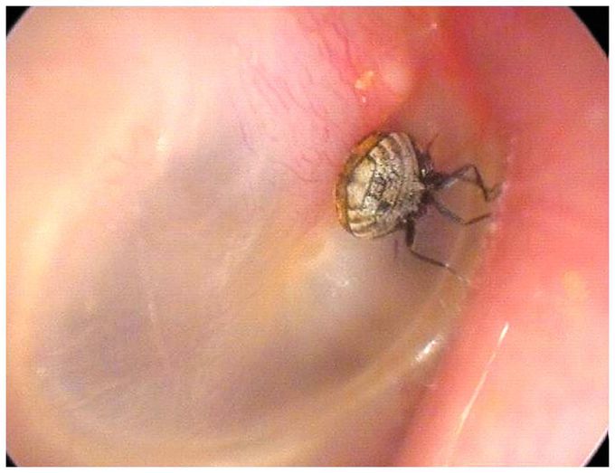 A Tickling in the Ear