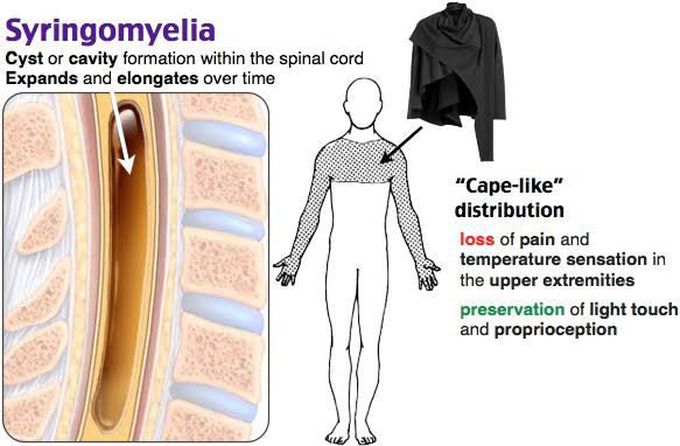 Syringomyelia