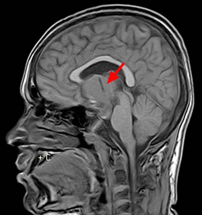 Craniopharyngioma