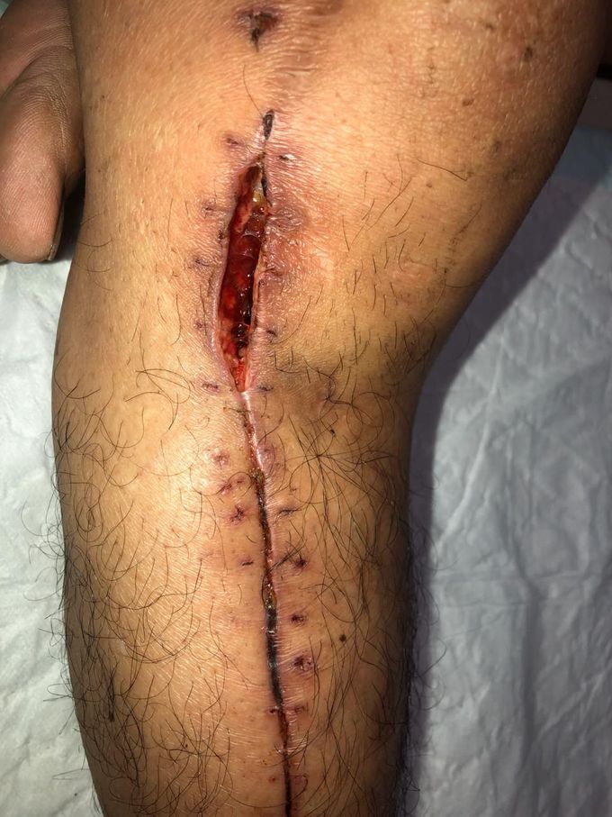 Wound Dehiscence