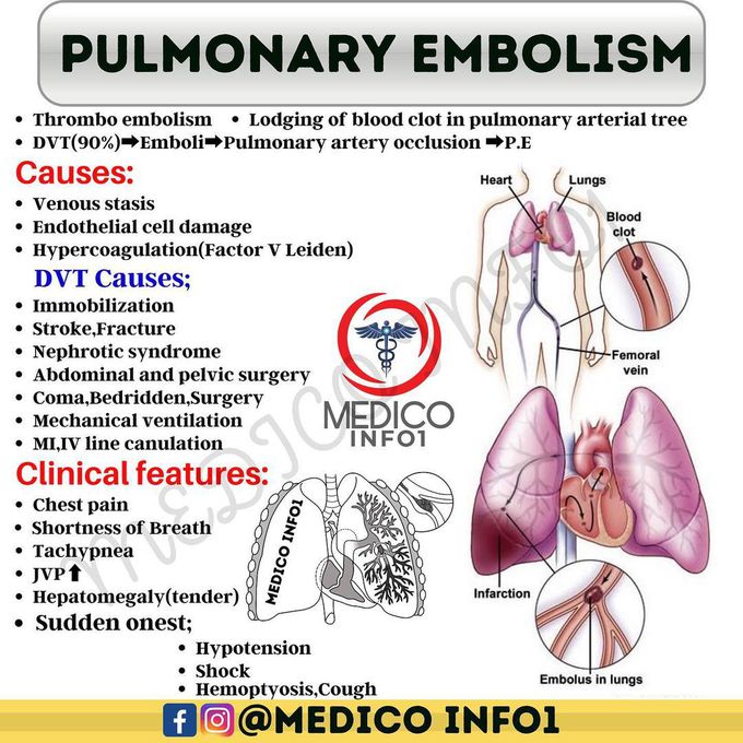 Pulmonary embolism