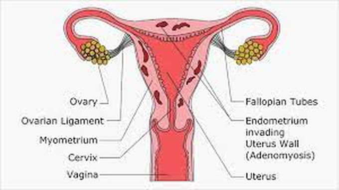 What are the signs of adenomyosis?