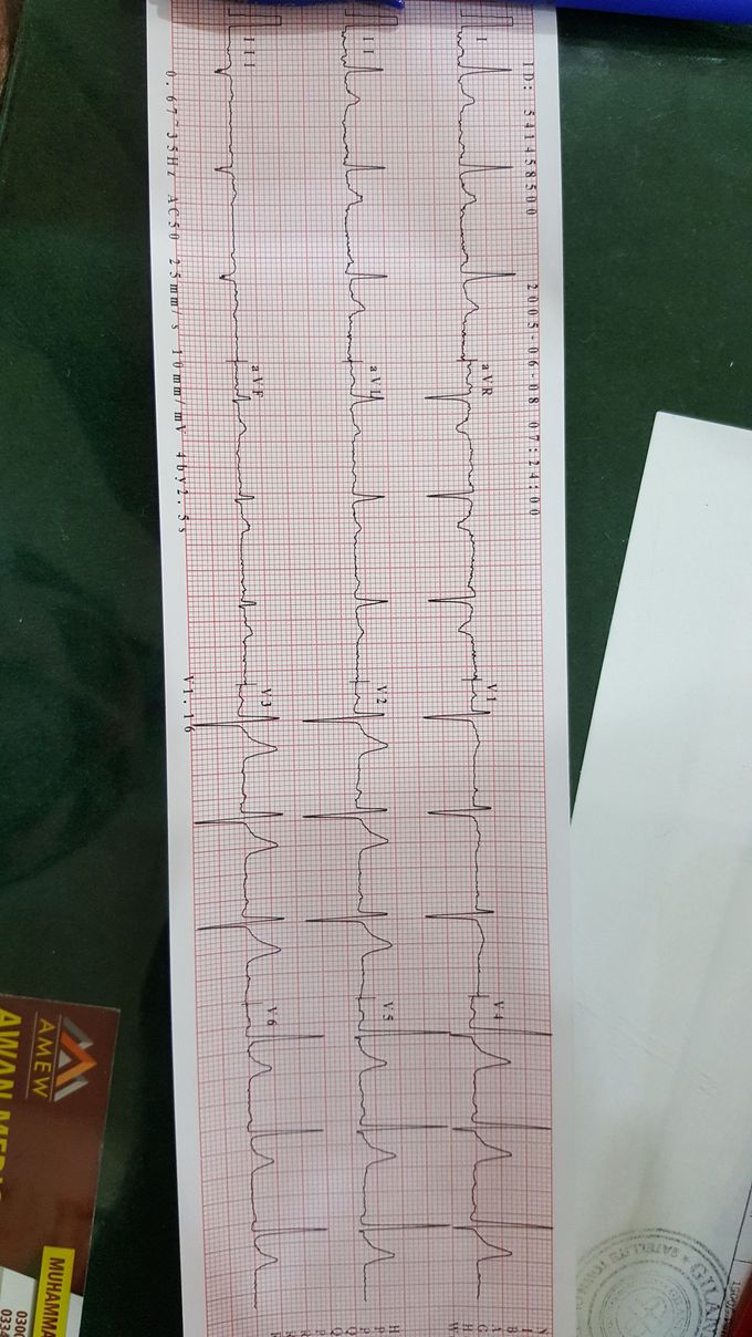 28 yr old man have sudden vertigo for just 5 to 10 second with mild SOB. Never before that what u saied about this.