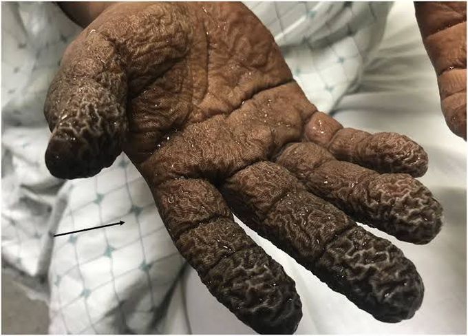 Organic Solvent Chemical Burns