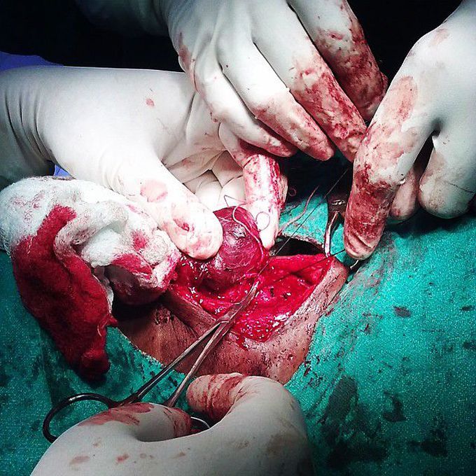 Thyroidectomy