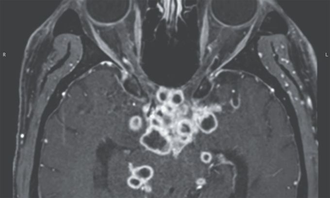 Tuberculous Optochiasmatic Arachnoiditis