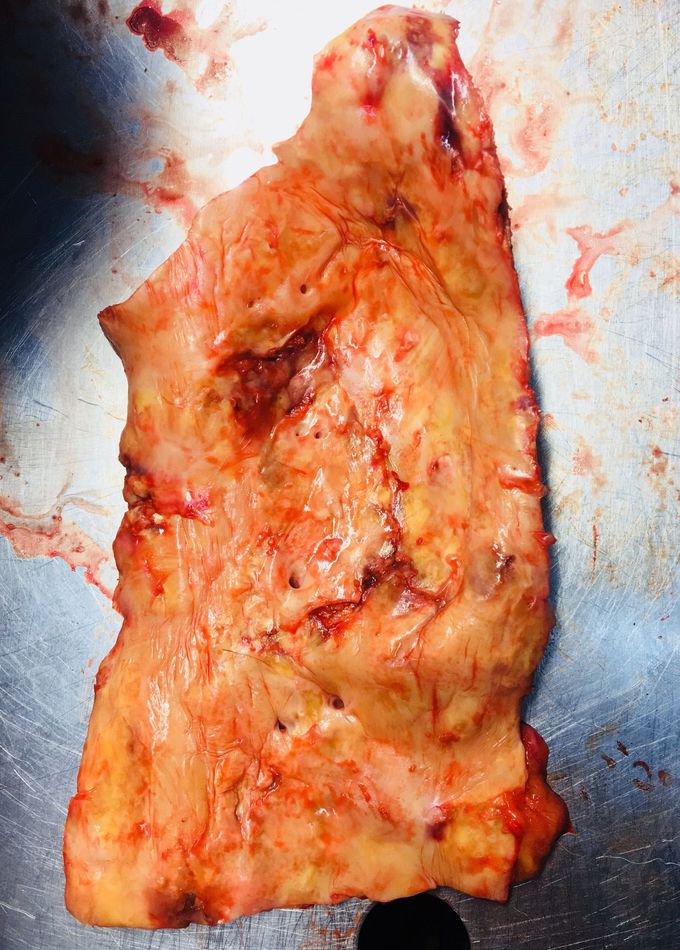 Thoracic aorta (atherosclerotic and ulcerative)