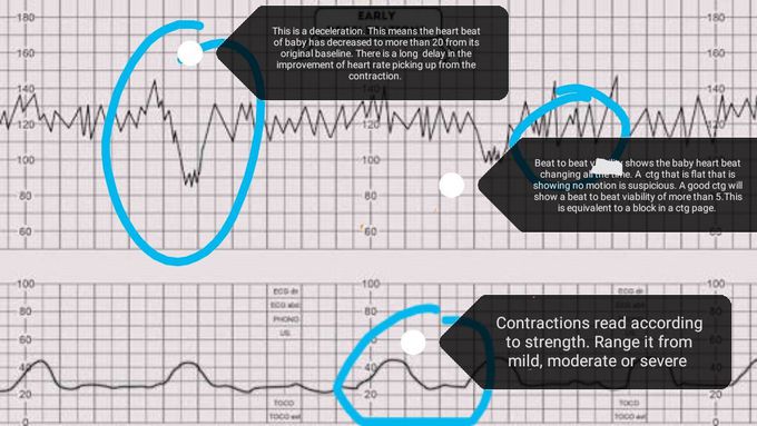 Ctg interpretation