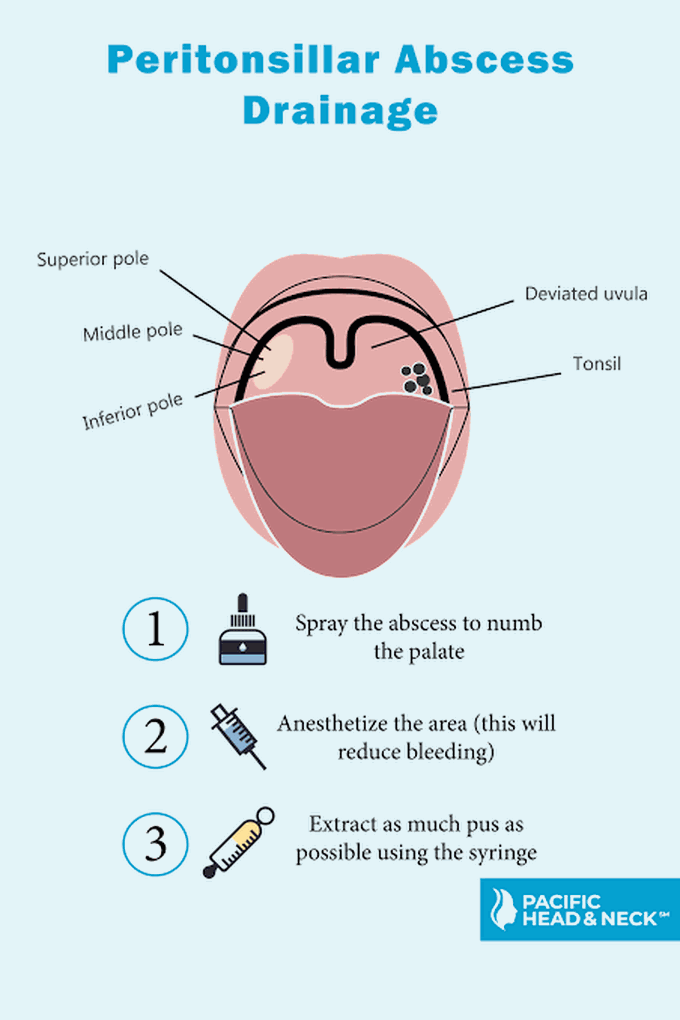 Treatment of peritonsillar abscess