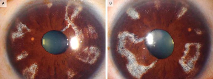 Iris Atrophy in Sickle Cell Disease