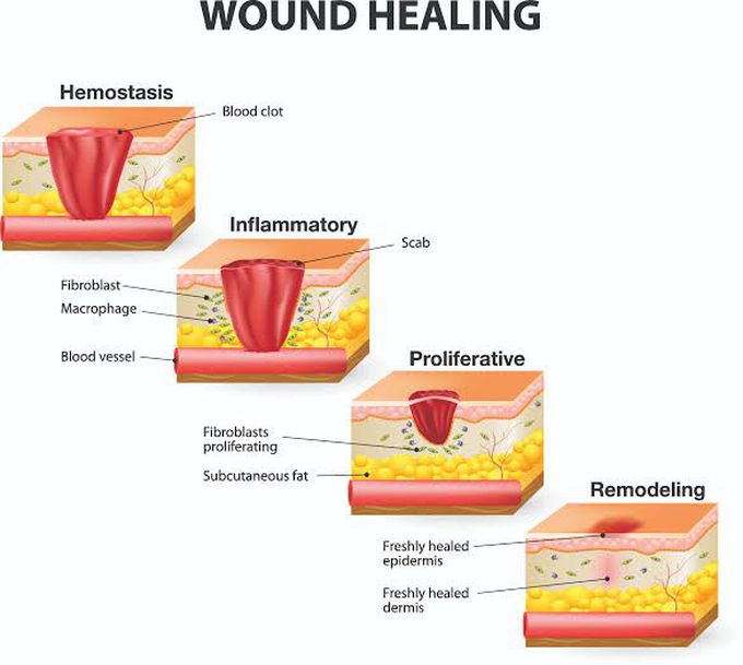 Phases of wound healing