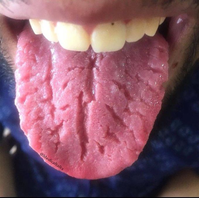 Fissured Tongue