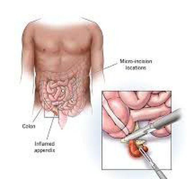 Appendectomy