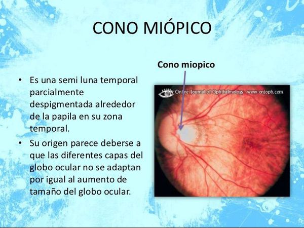 Miopie degenerativă Miopia degenerativa