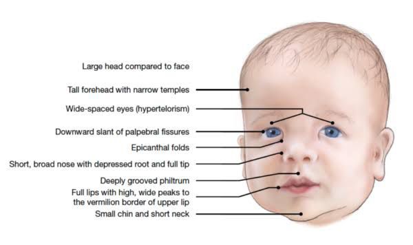 Symptoms and facial features of noonan syndrome - MEDizzy