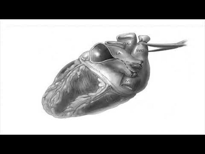 Donor Operation in Heart Transplantation