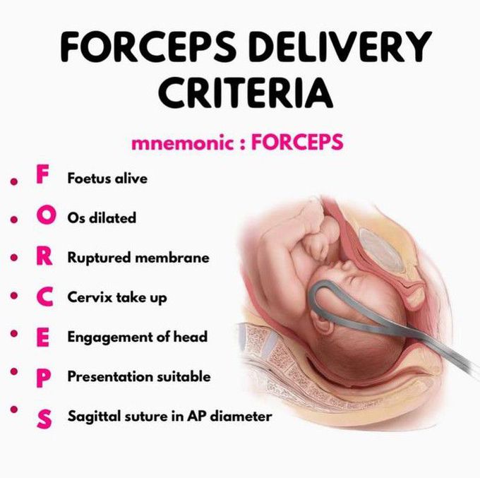 Forceps delivery criteria medizzy