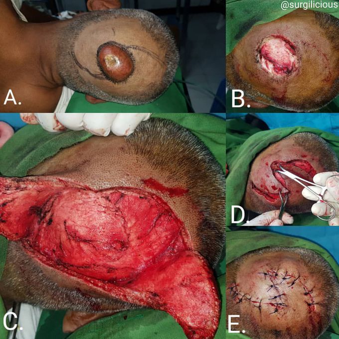 O to Z flap (local flap for scalp defect) 