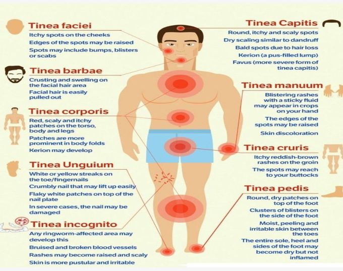 Major Fungal Diseases