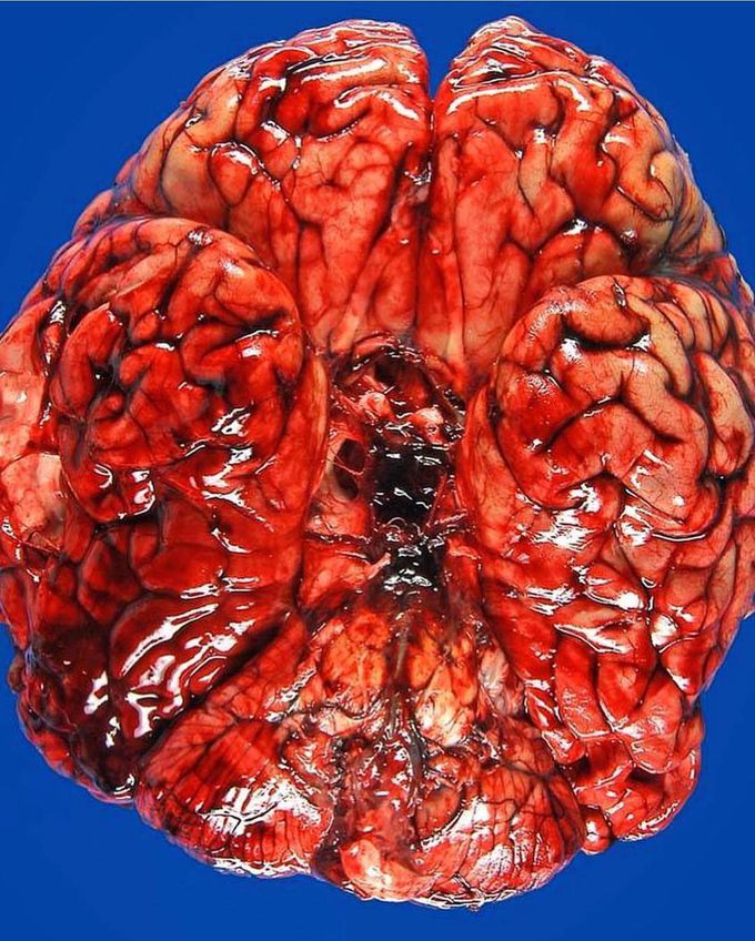 Ruptured aneurysm at the base of the brain that resulted in subarachnoid hemorrhage!