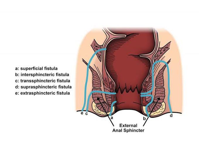 Fistula