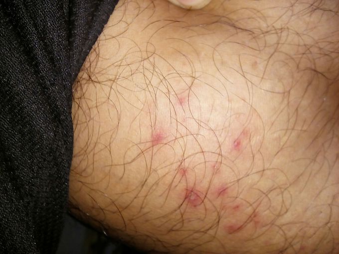 Reddish area near popliteal fossa