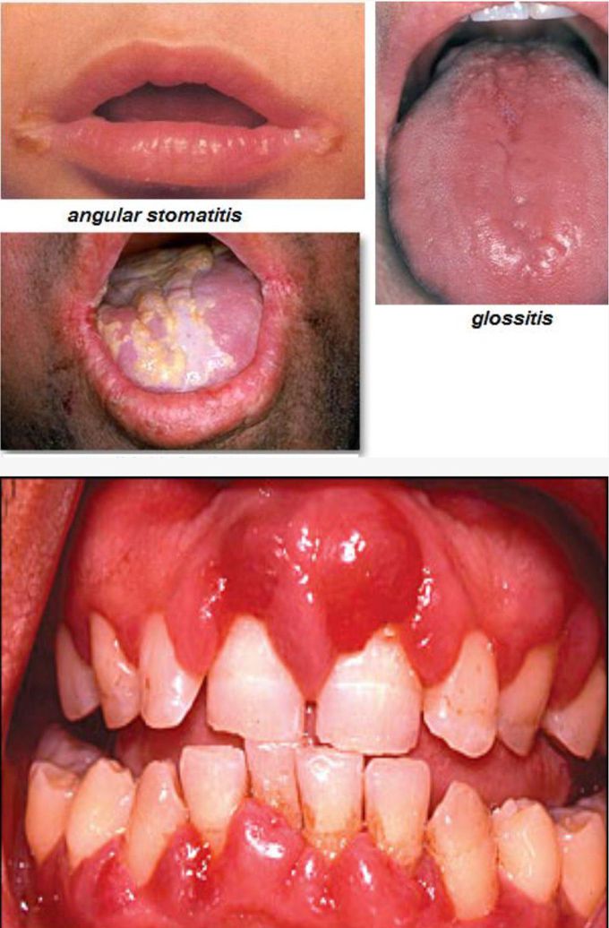 Identify the disease