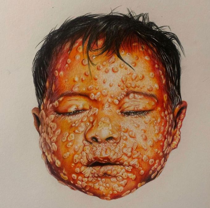 Coloured pencil illustration of a child with smallpox